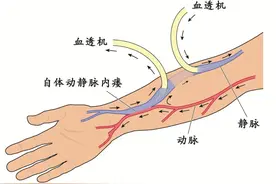 保护好血透生命线，你需要了解的动静脉内瘘知识图片