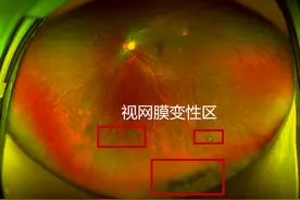 一个近视300多度的小伙眼底竟然千疮百孔图片