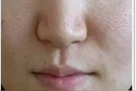 皮肤有这5个现象，说明螨虫已“超载”，除螨势在必行图片