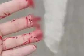 看着都疼！电梯人被夹断三根手指，注意作业安全图片
