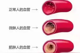 正常人与肥胖人血管对比图图片