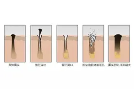 教你如何从根源解决黑头？（科学有效根治黑头的好方法）图片