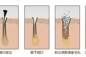 教你如何从根源解决黑头？（科学有效根治黑头的好方法）图片