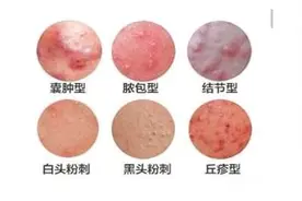 中国人脸上的“痘痘”，离皮肤科医生有多远？图片