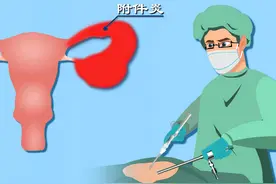 附件炎治疗期间要注意啥？细数附件炎治疗那些坑图片