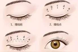 双眼皮是如何形成的？分为几种类型？图片