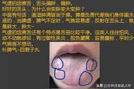 以为齿痕重就是有湿气了？错了，还有可能是这4种情况图片