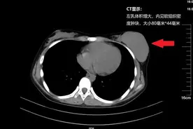 河南十岁女童左侧乳房疯长如“拳头”，检查发现大问题！娃有这些症状要当心图片