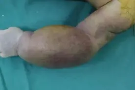 婴儿左臂变大呈青紫色，大医院医生束手无策，专家说法令人揪心图片