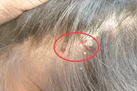 头皮里经常长出这种小疙瘩，到底是什么东西？看完千万要注意了视频封面