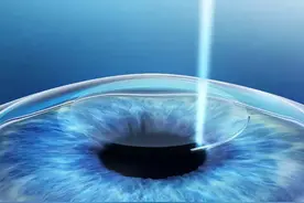 听很多人说，做完全飞秒手术都后悔了？图片