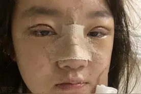 22岁小妹双眼皮隆鼻术后30天，朋友说换了一张脸图片