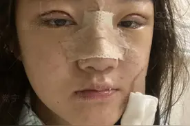 22岁小妹双眼皮隆鼻术后30天，朋友说换了一张脸图片
