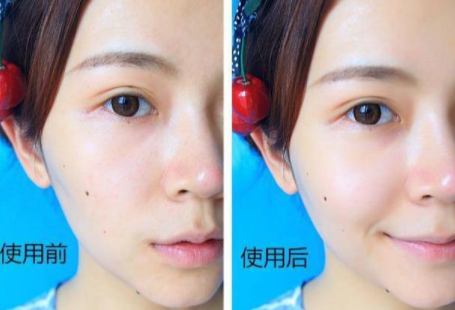 脸部下垂补充胶原蛋白有用吗 2026年脸部下垂补充胶原蛋白有用吗女生