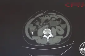 男子误吞半颗烂牙！引发急性阑尾炎，差点要了命图片