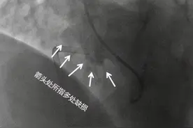 心脏上有5个洞！孕妇蒙了：我怎么能安稳活这么多年？图片