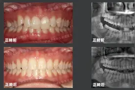 广州牙齿矫正丨解答案例分享：内倾型深覆合如何治疗？难度大吗？图片