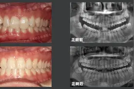广州牙齿矫正丨解答案例分享：内倾型深覆合如何治疗？难度大吗？图片