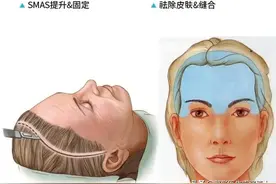 听医生细说：关于拉皮手术的20个真相图片