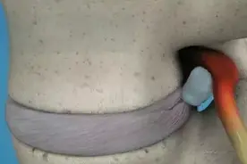 椎间隙高度对腰椎间孔狭窄有什么影响？图片