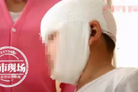面部伤口17处缝了近80针，4岁男童被自家狗咬伤！医生紧急提醒图片