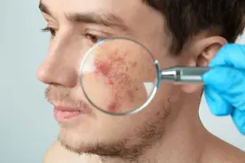 感染艾滋病，人可能会出现这4个表现！若都全占，劝你做好这件事图片