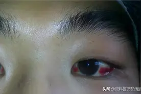 眼睛红了一大片别担心，深究病因早干预早安心图片