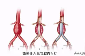 肚子里长了个东西和心脏同时跳动，泉州老太查出体内有“血管炸弹”，全家吓坏了图片