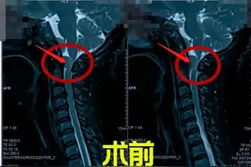 误诊成颈椎病的斜坡脊膜瘤：手麻、走路有踩棉感，不一定是颈椎病图片