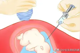 羊水穿刺真的有那么吓人吗？图片