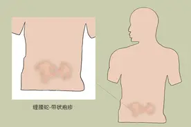 蛇盘疮是怎么来的？为什么民间有“缠一圈要人命”的说法？图片