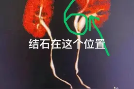 身患肾结石却难寻踪影，医生30分钟帮患者走出“碎石迷宫”图片