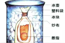 做饭砍骨头不慎砍断两手指，紧急再植手术终于“救活”图片