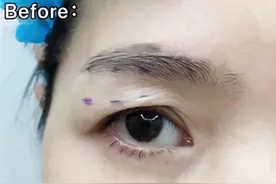 做过提眉手术的人，才会知道的几件事图片
