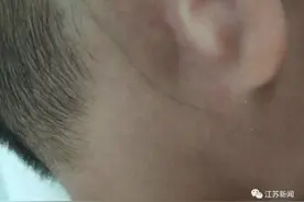 4岁男孩皮肤下有一根黑线，还会延长移动！医生惊了：中国仅3例图片