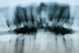 烂牙根不拔，两年后恶变成癌，医生提醒：注意3点，预防舌癌发生图片