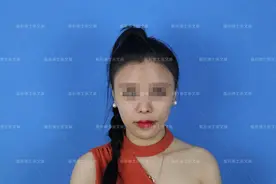 「案例分析」20岁姑娘，想把贴发耳矫正成招风耳图片