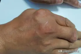 痛风20年长出痛风石，尝试“偏方”险中毒，尿酸高用药有讲究图片