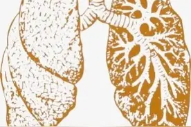 依靠人工肺生存8天后接受肺移植成功，极危重患者闯过“鬼门关”图片