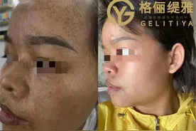 斑点治疗很简单图片