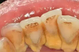 “牙结石”可以自己抠掉吗？教你一招，牙缝的脏东西或能轻松掉图片