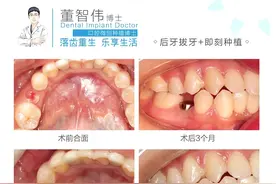 案例分享：后牙拔牙+即刻种植+延期修复图片