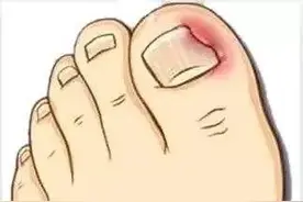 趾甲总往肉里长，怎么办？图片