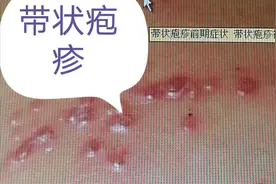 回忆我初中时期治疗带状疱疹的经历图片