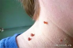 脖子上长了好多小肉疙瘩，有可能是感染病毒！教你丝状疣该怎样治图片