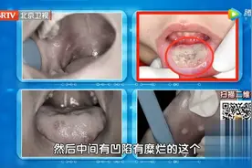 “口腔溃疡”老不好？检查发现竟是癌了！要小心这些生活习惯图片