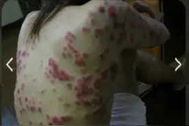 聊天记录爆出真实的人间，老公说工作太累了长湿疹，其实是梅毒图片