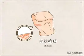 健康科普堂 | 这种皮肤病，一点就“破”图片