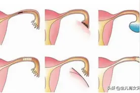 遇到输卵管问题我们该如何选择？图片