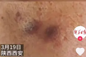 男子年会2次被领导用烟头烫脸，网友炸了！人到中年，满眼心酸图片